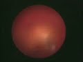 Ureterorenoskopi