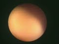 Ureterorenoskopi