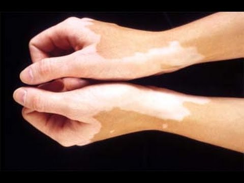 how to cure white spot