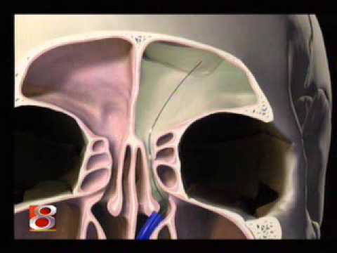 how to treat chronic sinusitis