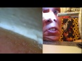 Extraction of Open Comedones (Blackheads) by Pore Strip - MICROSCOPE