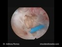 Arthroscopic Subscapularis Repair with Anthony A. Romeo, M.D., Part 1 Arthroscopic Subscapularis Repair with Anthony A. Romeo, M.D., Part 1