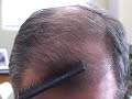 HAIR TRANSPLANT JOURNEY 2