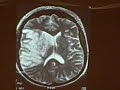 Right MCA Stroke