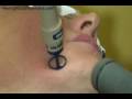 Light Touch Laser - Pixel® for texture and tone PART 5