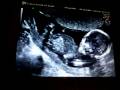 Ultrasound Week 15 Video
