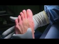 Voet operatie (Hallux Valgus) bij Bergman Clinics in tv programma Dit is mijn lijf