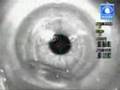 Eyes Operation w/ LASIK
