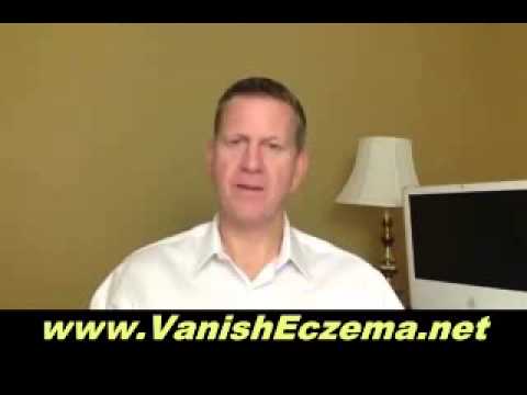how to stop yourself from scratching eczema