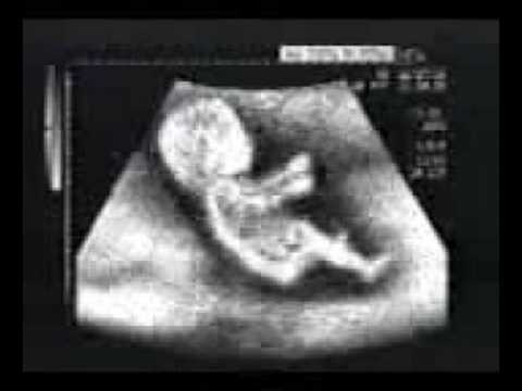Früh übt sich! - In mir steckt ein Rennfahrer ;) Ein Ultraschall wo das Baby richtig Gas gibt.