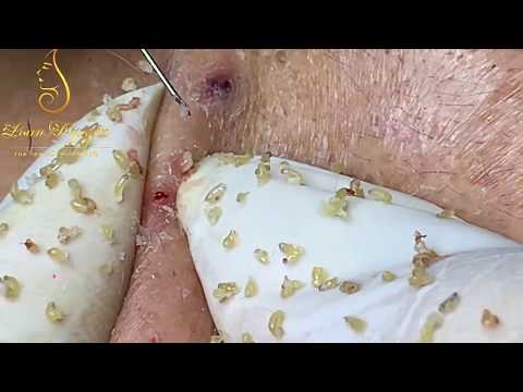 Mụn ẩn kín mặt 2 | Acne hidden face | Loan Nguyen