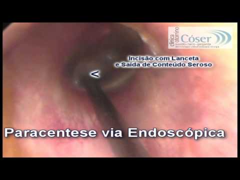 how to perform paracentesis