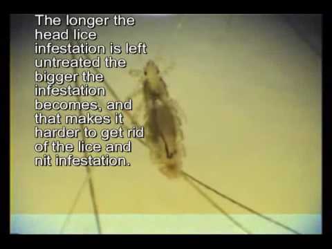 how to treat head lice nz