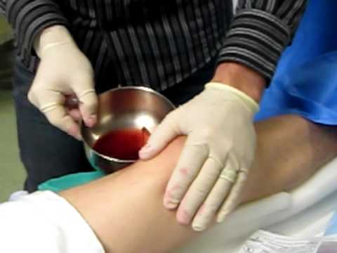 how to drain fluid from knee
