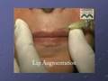 videos de FACE Conference 2005 Matridur Filler