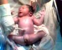 Jamesbond Custodio *cesarian birth