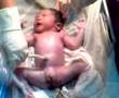 Jamesbond Custodio *cesarian birth