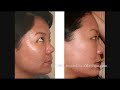 Laser Acne Scar Removal Treatment - Asian Patient Laser Acne Scar Removal Treatment - Asian Patient