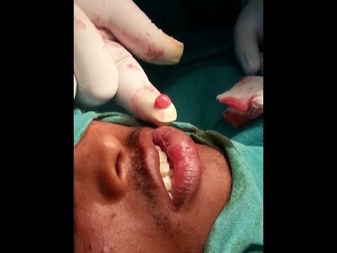 how to unclog sebaceous cyst