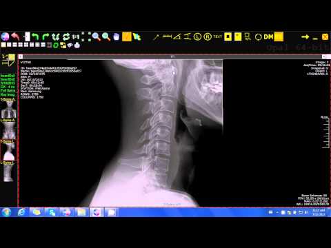 how to measure cervical curve on x-ray