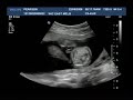 19 week ultrasound scan