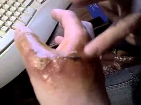 how to relieve oil burns