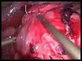 Laparoscopic gastric band, LapBand revision (slip/pouch dilatation)