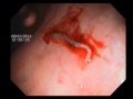 Worm in Endoscopy Worm in Endoscopy