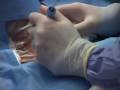Blue Rhino Percutaneous Tracheostomy (External View)