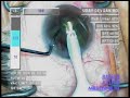 cataract surgery, phaco eye, Uday Devgan MD Los Angeles, CA cataract surgery, phaco eye, Uday Devgan MD Los Angeles, CA