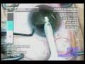 Cataract Surgery - Phacoemulsification Cataract Surgery - Phacoemulsification
