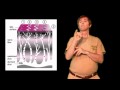 Herpes Zoster Shingles