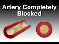 Angina and Heart Attacks (Health Tip) Angina and Heart Attacks (Health Tip)