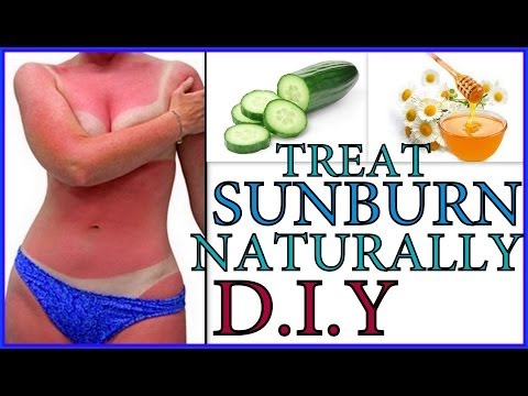 how to cure sunburn face