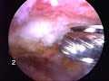 Arthroscopy: Subacromial Decompression by Ford Qureshi