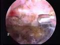 Arthroscopy: Subacromial Decompression by Ford Qureshi