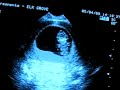 Ultrasound 9 weeks 3 days