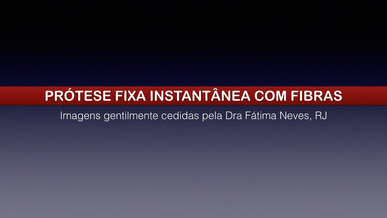 Protese fixa instantânea com fibra - Dra Fátima Neves