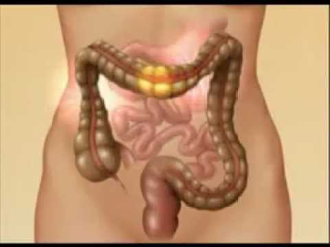 how to relieve bowel pain