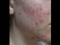 The Acne Practice  (Home Version 21)  -- Unbelievable Update