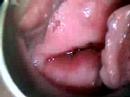 colposcopy