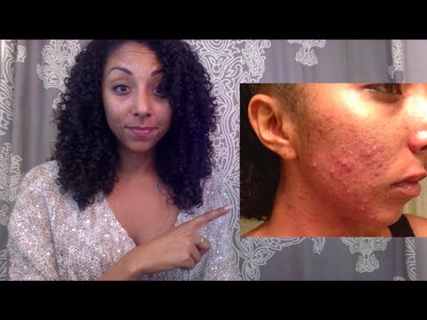 How I Got Clear Skin with Birth Control | BiancaReneeToday