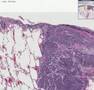 Histopathology Lung, subpleural--Metastatic small cell carci