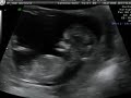 Bub at 12 weeks