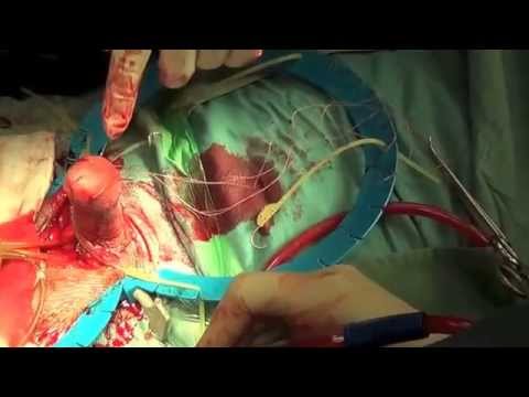 how to cure penile oedema