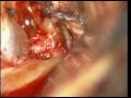 BRAIN ANEURYSM-ACOM A-, OPENING OF LAMINA TERMINALIS -dr suresh dugani/HUBLI/INDIA