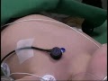 JET Beatmung 5d Fremdkörper Extraktion Kind 17 Monate Sicht Thorax Exkursion