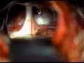 Microvascular Decompression of Trigeminal Neuralgia Microvascular Decompression of Trigeminal Neuralgia