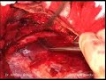 Scapulothoracic Fusion for Fascoscapulohumeral Muscular Dystrophy, Part 3 Scapulothoracic Fusion for Fascoscapulohumeral Muscular Dystrophy, Part 3