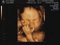 baby-dillon-4d-ultrasound.html
